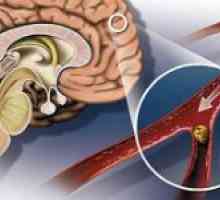 Ateroscleroza vaselor cerebrale și a simptomelor sale