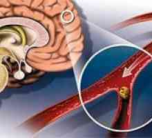 Ateroscleroza vaselor cerebrale ale creierului