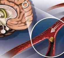 Ateroscleroza cap: cauzele sale, simptome și tratament