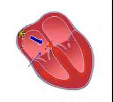 Bloc atrioventricular (AV) inima: cauze, masura, simptome, diagnostic, tratament