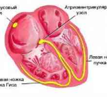 Bloc atrioventricular inima