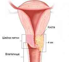 Sfatul bunicii impotriva formatiunilor pe colul uterin