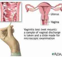 Vaginoza bacteriană (coleitis) - simptome, metode de diagnostic și tratament