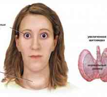 Endocrine Graves boala (boala Graves): cauze, simptome, tratament si prevenire