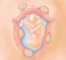 Sarcina și nașterea uterine miom