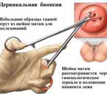 O biopsie de eroziune de col uterin