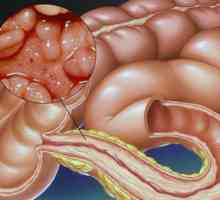 Boala Crohn: principalele caracteristici, simptome, diagnostic si tratament