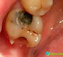 Durere de dinți pentru umplere temporară: Ai nevoie să sune alarma