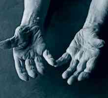 Dureri la nivelul articulatiilor degetelor: tratamentul și prevenirea
