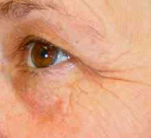 Botox-ul pe pielea din jurul ochilor - comentarii și descriere
