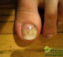 Ajutor rapid de la folk căile de atac ciuperca unghiilor
