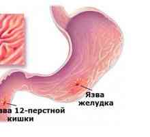 Metodele de tratament al ulcerului gastric și ulcer duodenal