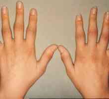 Cauzele cele mai frecvente edeme ale degetelor