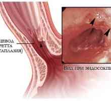 Ce amenință metaplazia esofagului?