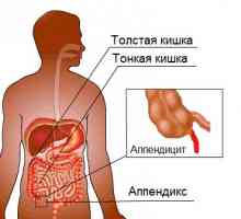 Simptomatologia de apendicita la femei