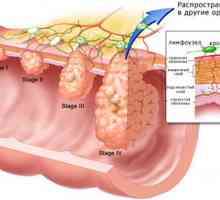 Patru etape de cancer la stomac