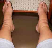 Ce se poate face cu picioare edem după naștere