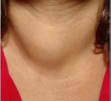 Ce este nodul tiroidian coloidal și cum să-l trateze
