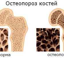 Ce fel de osteoporoza boli osoase