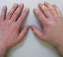 Ce ar trebui să fac în cazul în care umflarea mâinilor după somn