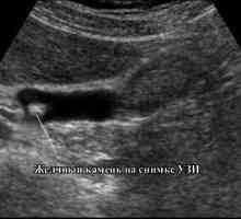 Ce vezica biliara cu ultrasunete?