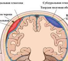 Simptomele și tratamentul hematom epidural al creierului
