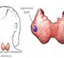 Ce este un adenom tiroidian, tipuri si tratamentul acesteia