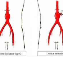 Ce este un anevrism al aortei abdominale?