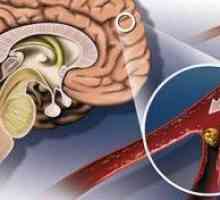 Ce este ateroscleroza cerebrală? Tratament, simptome și cauze ale bolii.