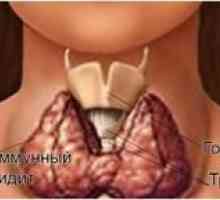 Ce este tiroidita Hashimoto tiroidian, cimptomy și tratamentul bolilor