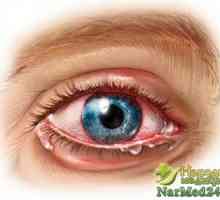 Ce este ochiul iridociclita și cum să se ocupe cu boala