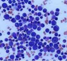 Leucocitoza (crescute globule albe în sânge): norma sau patologie?