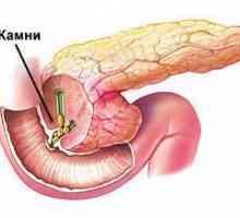 Ce este pancreatita acută