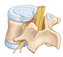 Ce este o proeminență de disc lombare a coloanei vertebrale? Metode de tratament și de prevenire.