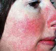 Ce este rozacee sau acnee rozacee: cauze, simptome, prevenirea