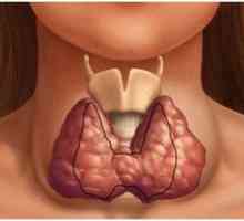 Ce este hipertiroidism: cauze, simptome, diagnostic și tratament