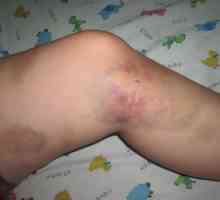 Ce este un prejudiciu picior, și mai ales tratamentul acesteia