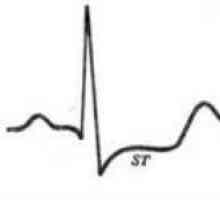Semne ECG de angină cardiacă