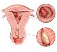Ce este hiperplazia endometrială glandulocystica