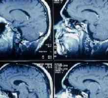 Capacitățile de diagnosticare ale vaselor cerebrale RMN
