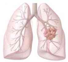 Diagnosticul și tratamentul cancerului pulmonar