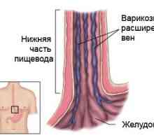 Diagnosticul și tratamentul varicelor esofagiene