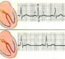 Diagnostic si simptome de tahicardie cardiacă