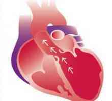 Dilatarea camerele inimii, aortă - conditii, simptome, diagnostic, tratament