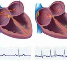 Atrial (intermitent) aritmie cardiacă