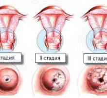 Displazia de col uterin 1, 2 și 3 grade - atunci când vindecarea nu este prea târziu?
