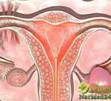 Tratamentul adecvat de remedii populare apoplexie ovariană