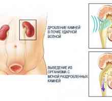 Fragmentarea de pietre la rinichi cu ultrasunete