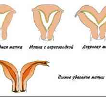 Uter bicorn: structura organelor genitale anomalie