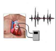Phonocardiography (PCG): ce este, capacitățile de diagnosticare, interpretarea